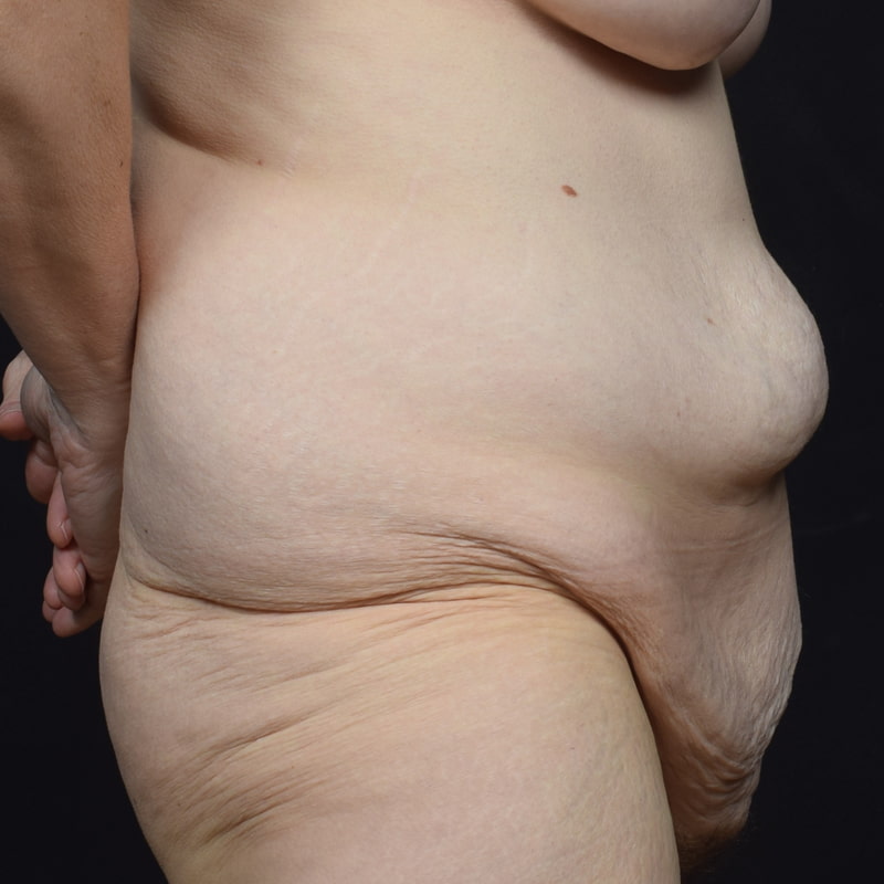 Tummy Tuck Before & After Image