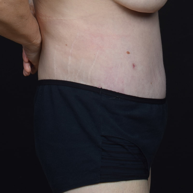 Tummy Tuck Before & After Image