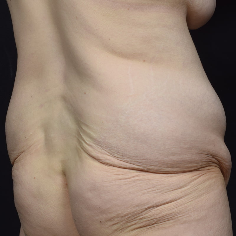 Tummy Tuck Before & After Image