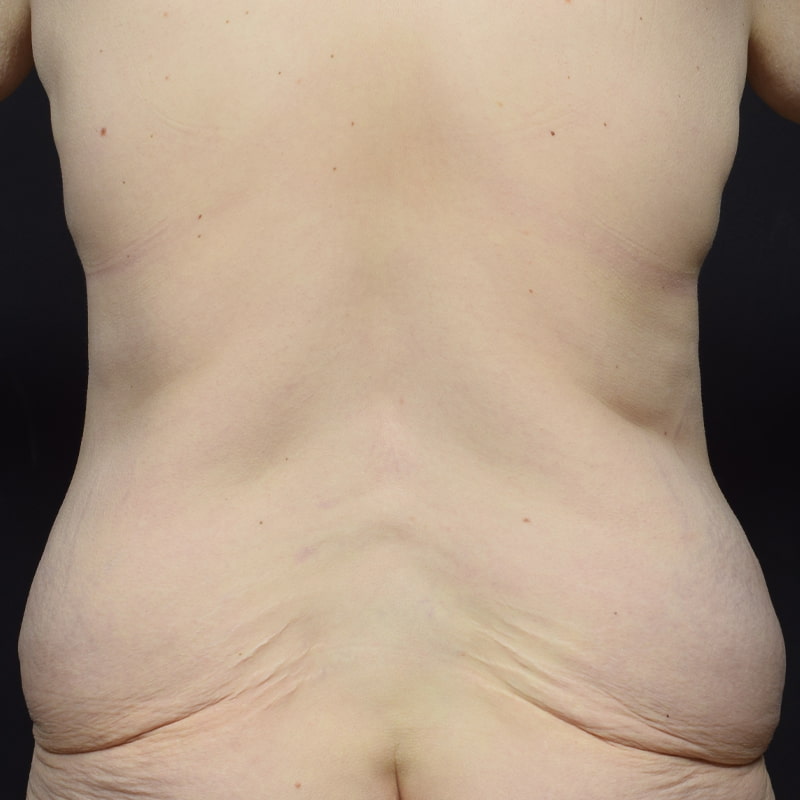 Tummy Tuck Before & After Image