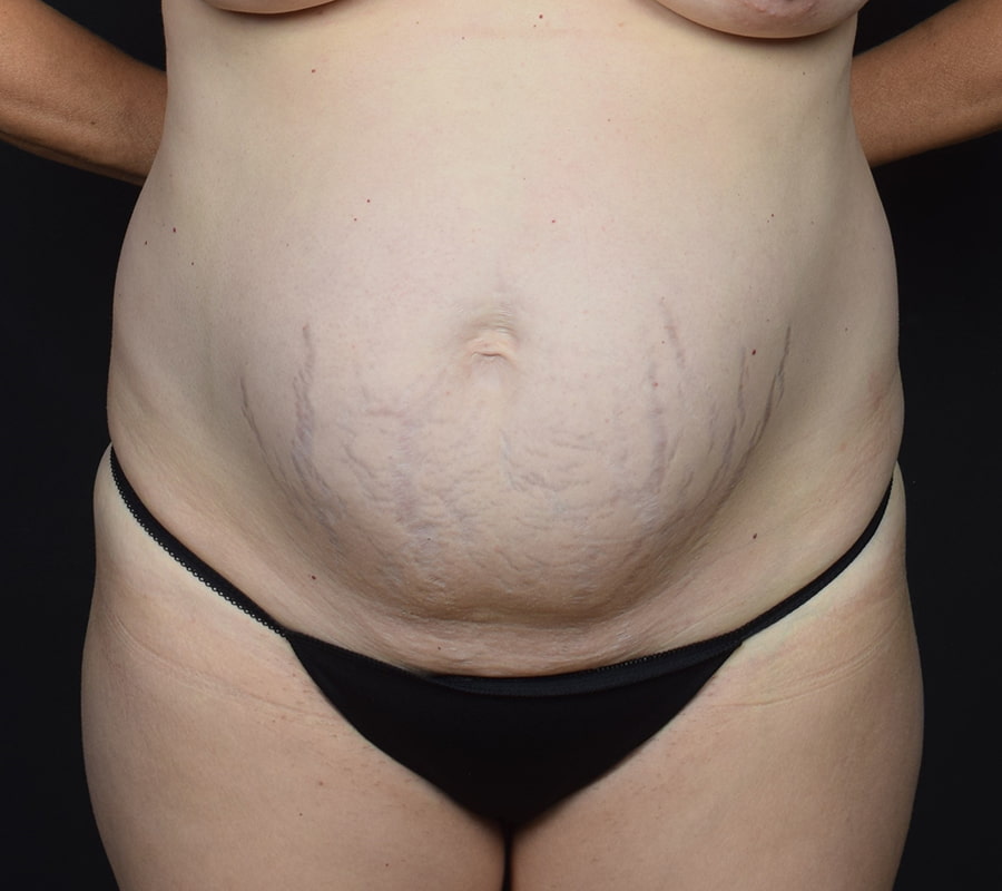 Tummy Tuck Before & After Image