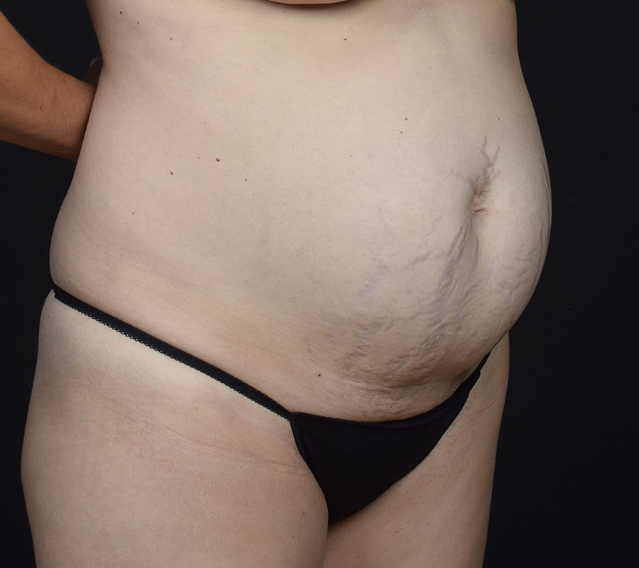 Tummy Tuck Before & After Image