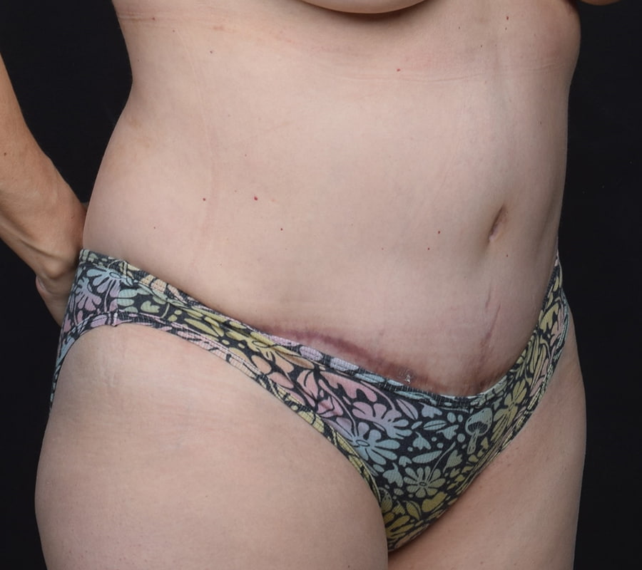 Tummy Tuck Before & After Image