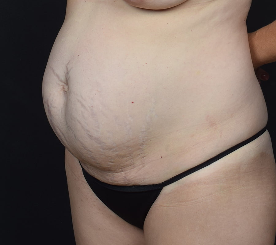 Tummy Tuck Before & After Image