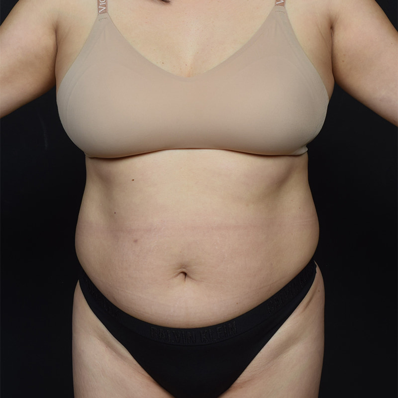 Tummy Tuck Before & After Image