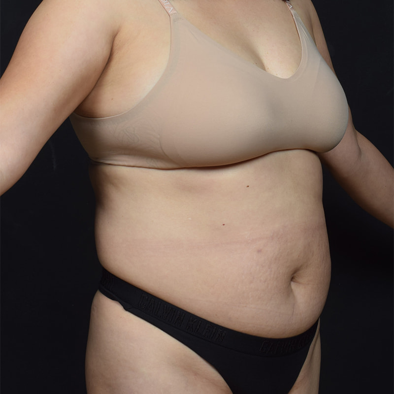 Tummy Tuck Before & After Image