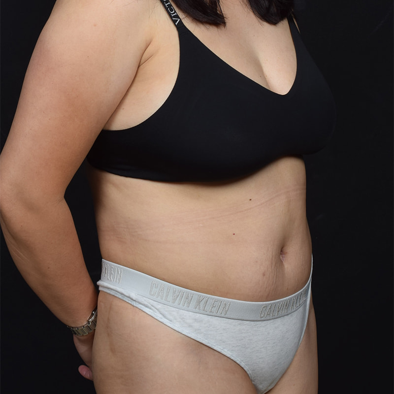 Tummy Tuck Before & After Image