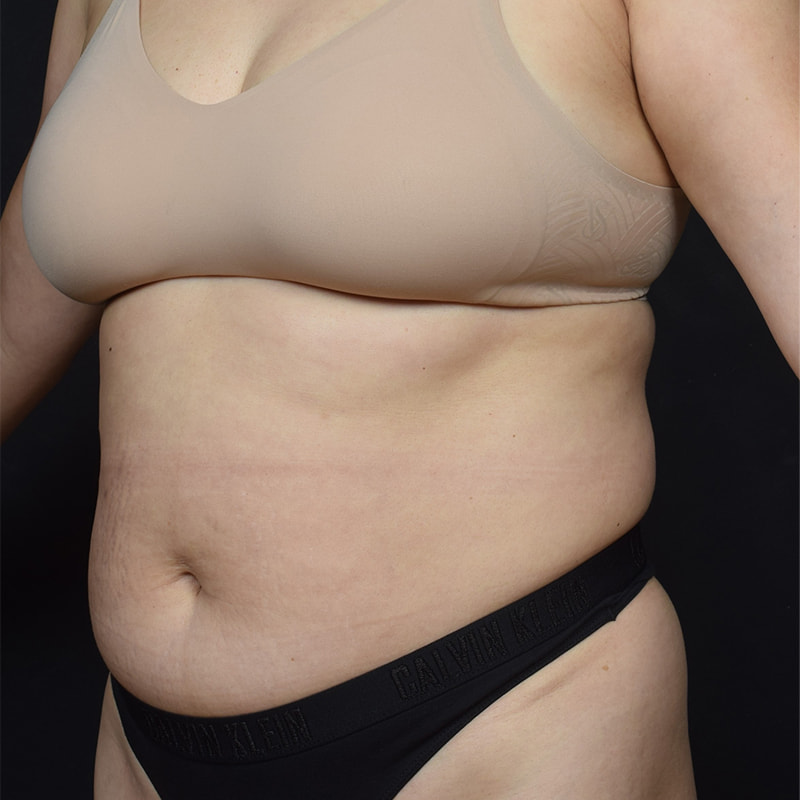 Tummy Tuck Before & After Image