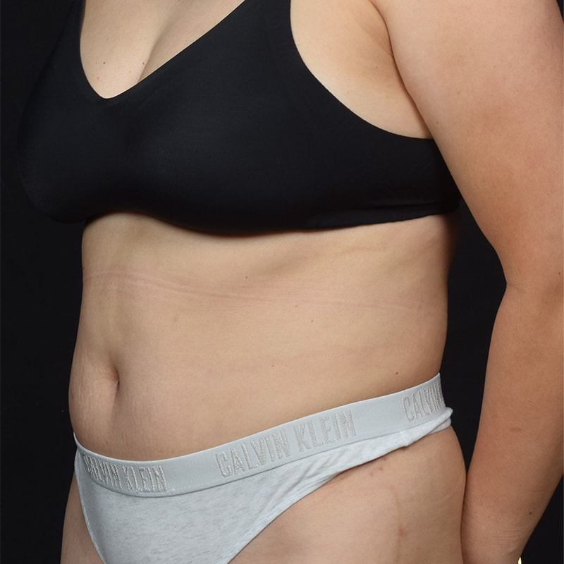 Tummy Tuck Before & After Image