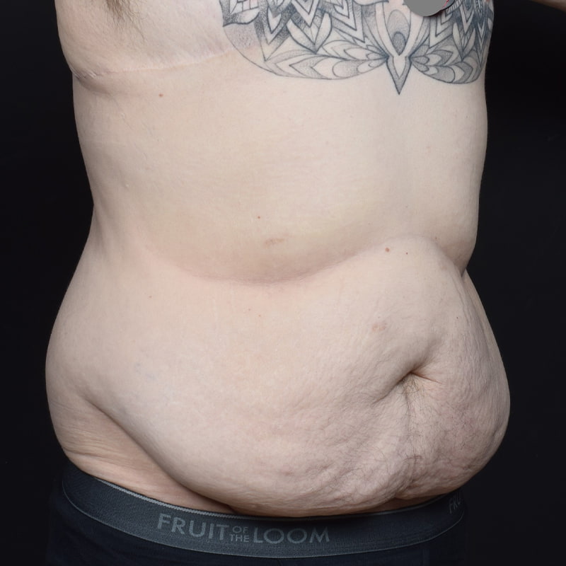 Tummy Tuck Before & After Image