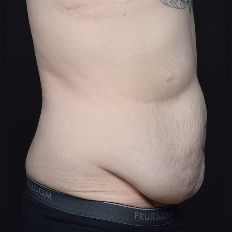 Tummy Tuck Before & After Image