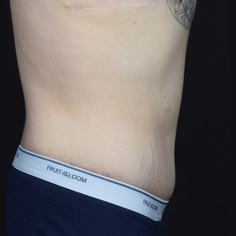 Tummy Tuck Before & After Image