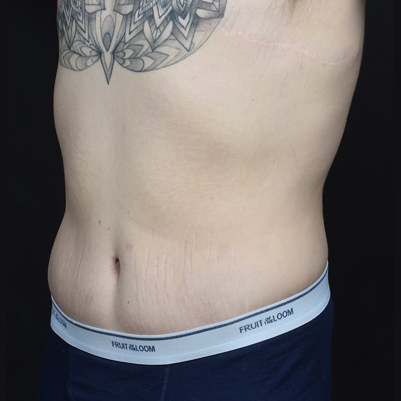 Tummy Tuck Before & After Image