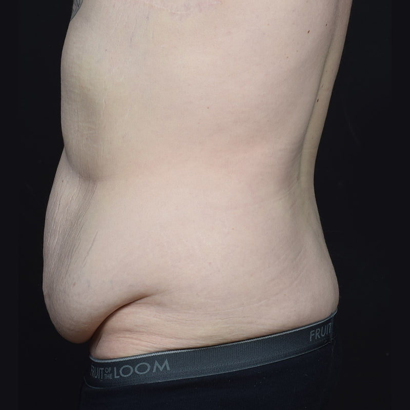 Tummy Tuck Before & After Image