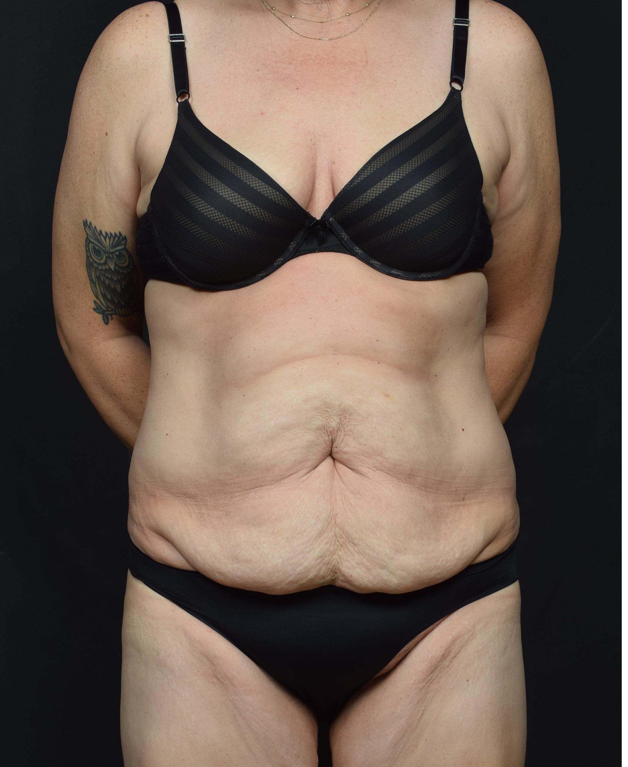 Tummy Tuck Before & After Image