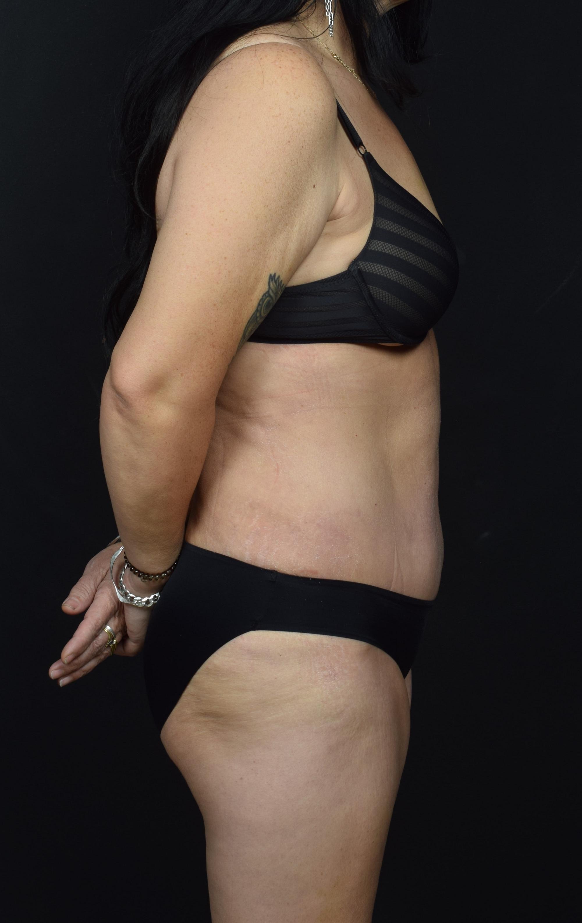 Tummy Tuck Before & After Image