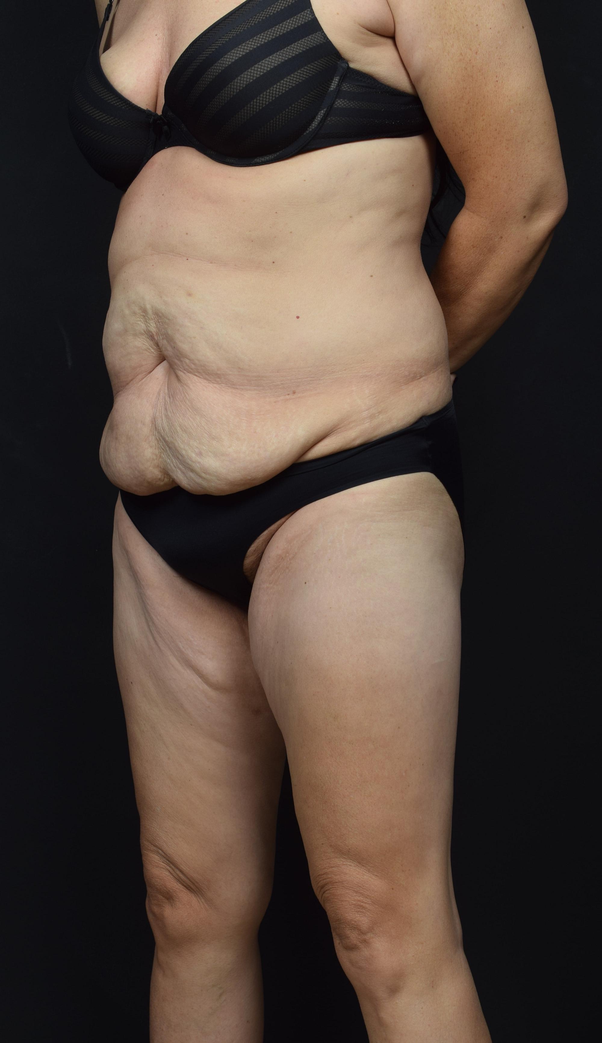 Tummy Tuck Before & After Image