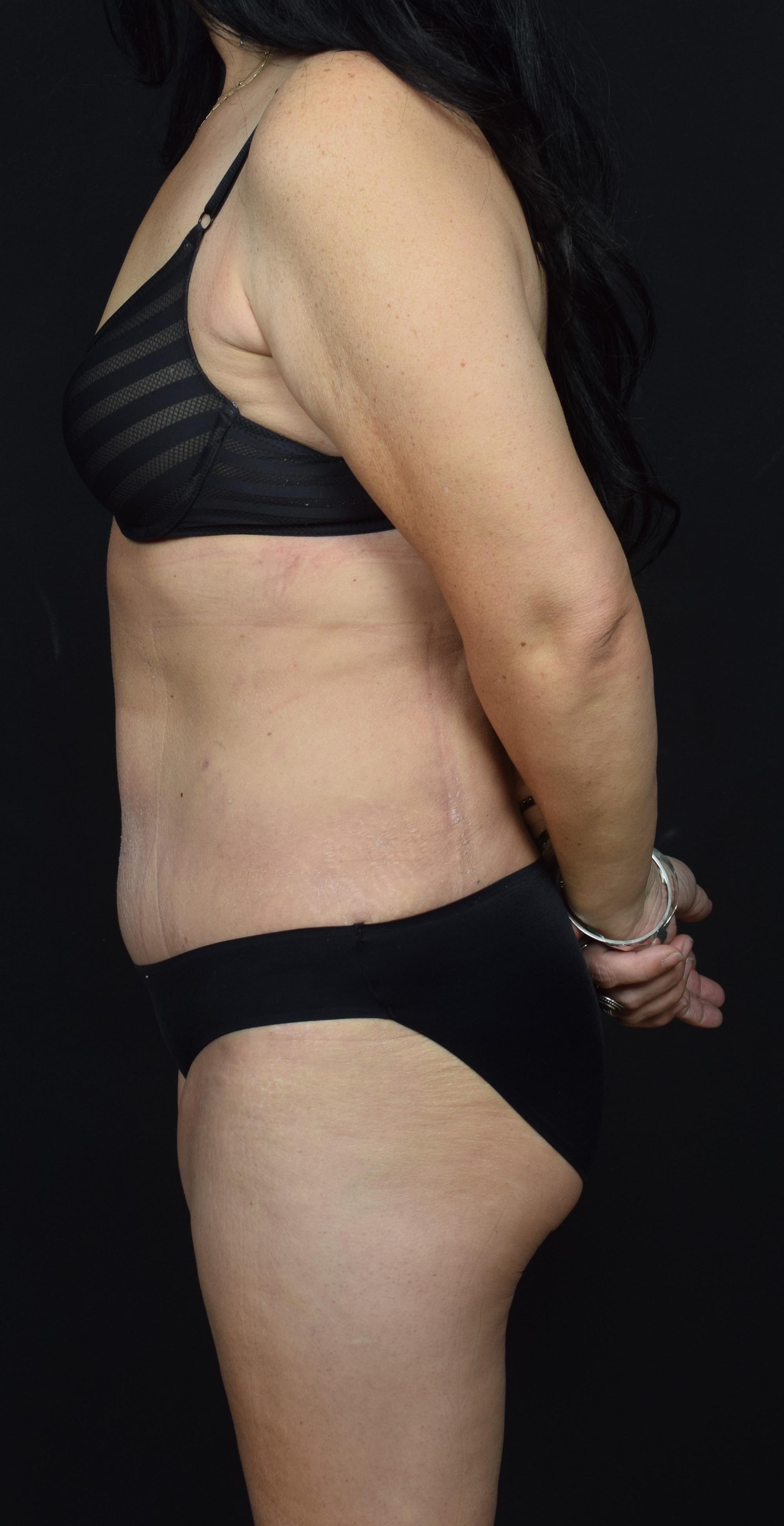 Tummy Tuck Before & After Image