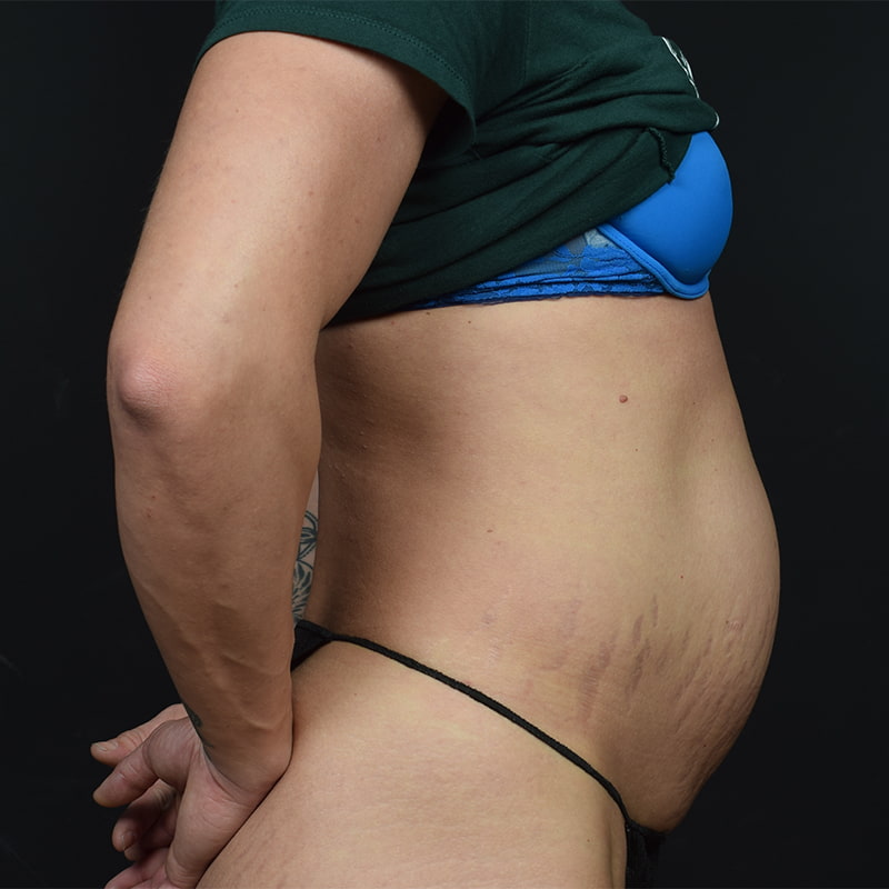 Tummy Tuck Before & After Image