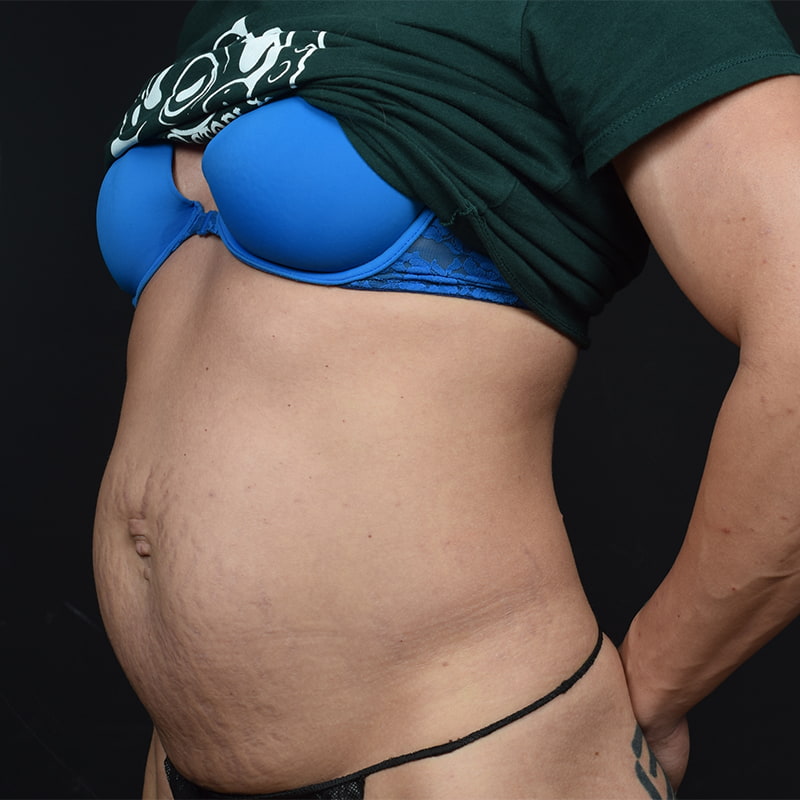 Tummy Tuck Before & After Image