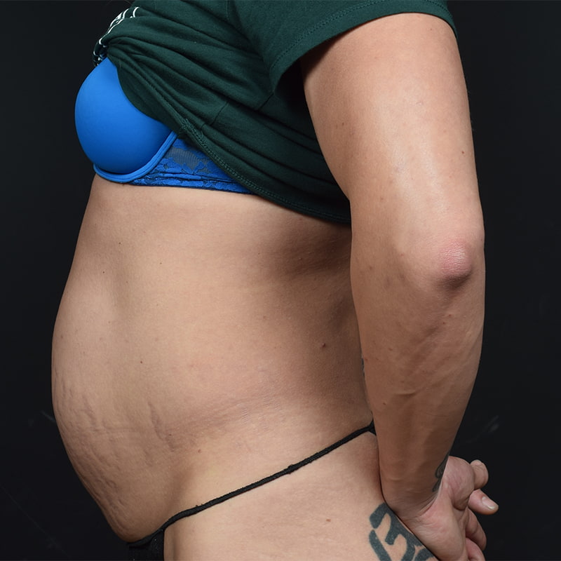 Tummy Tuck Before & After Image