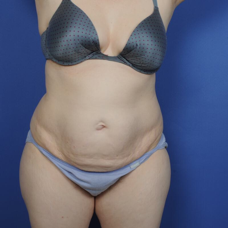 Tummy Tuck Before & After Image