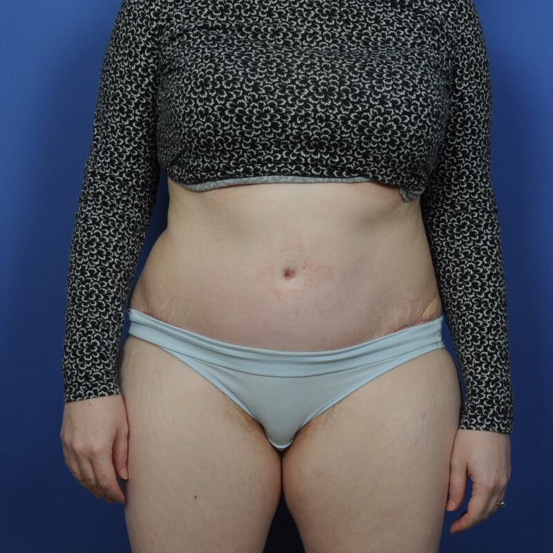 Tummy Tuck Before & After Image