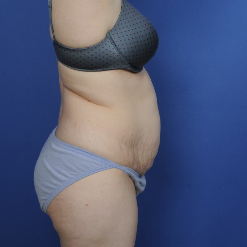 Tummy Tuck Before & After Image