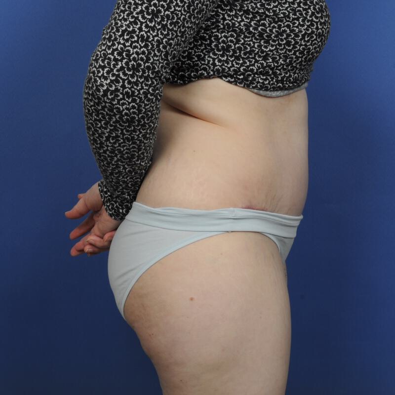 Tummy Tuck Before & After Image