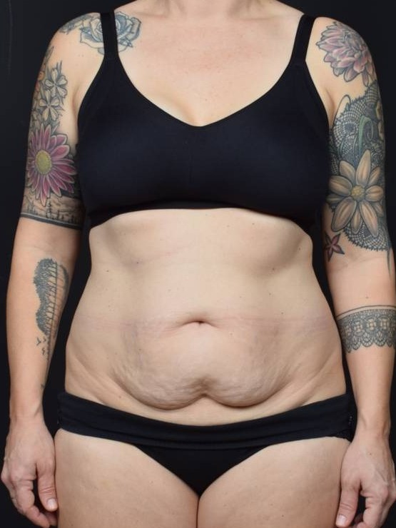 Tummy Tuck Before & After Image