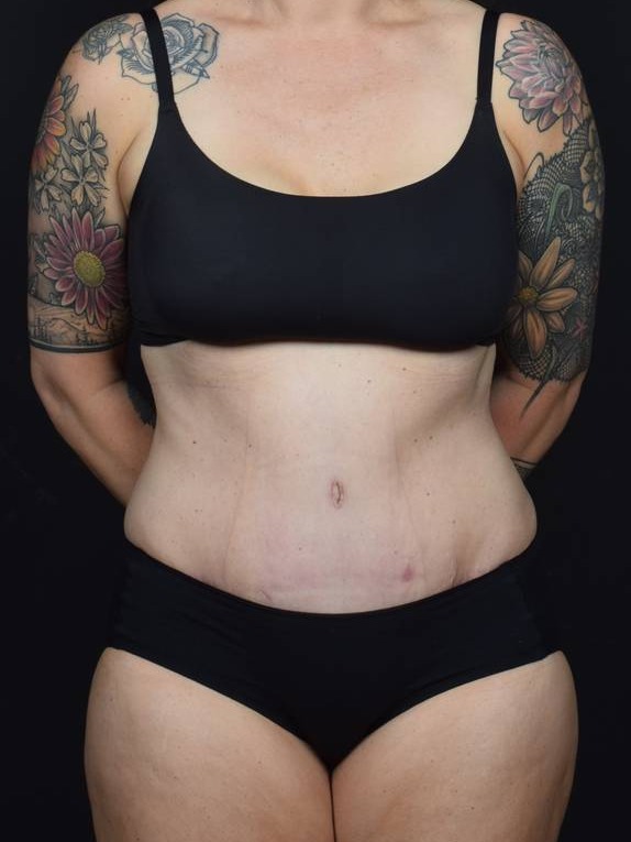 Tummy Tuck Before & After Image