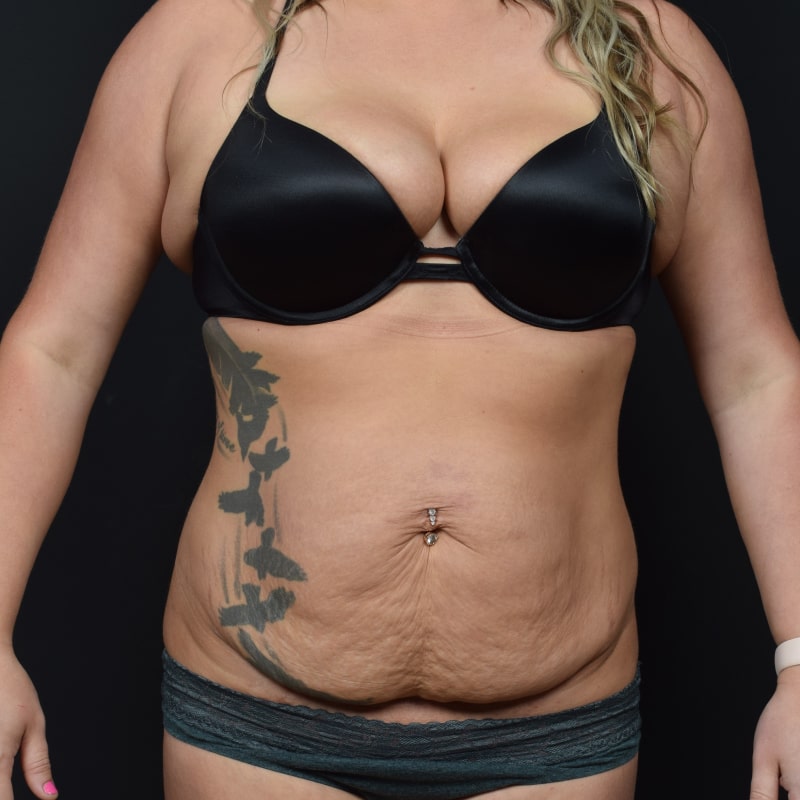 Tummy Tuck Before & After Image