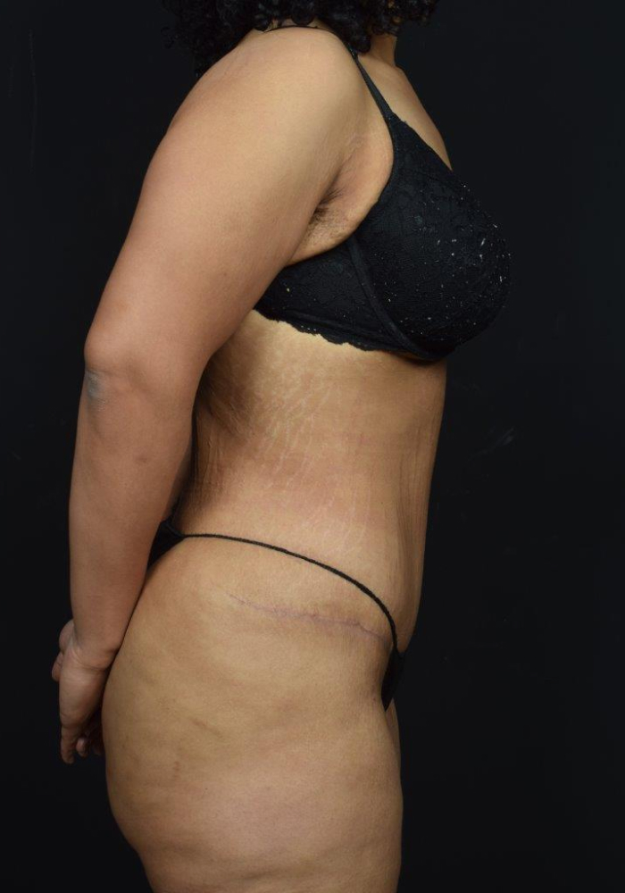 Tummy Tuck Before & After Image