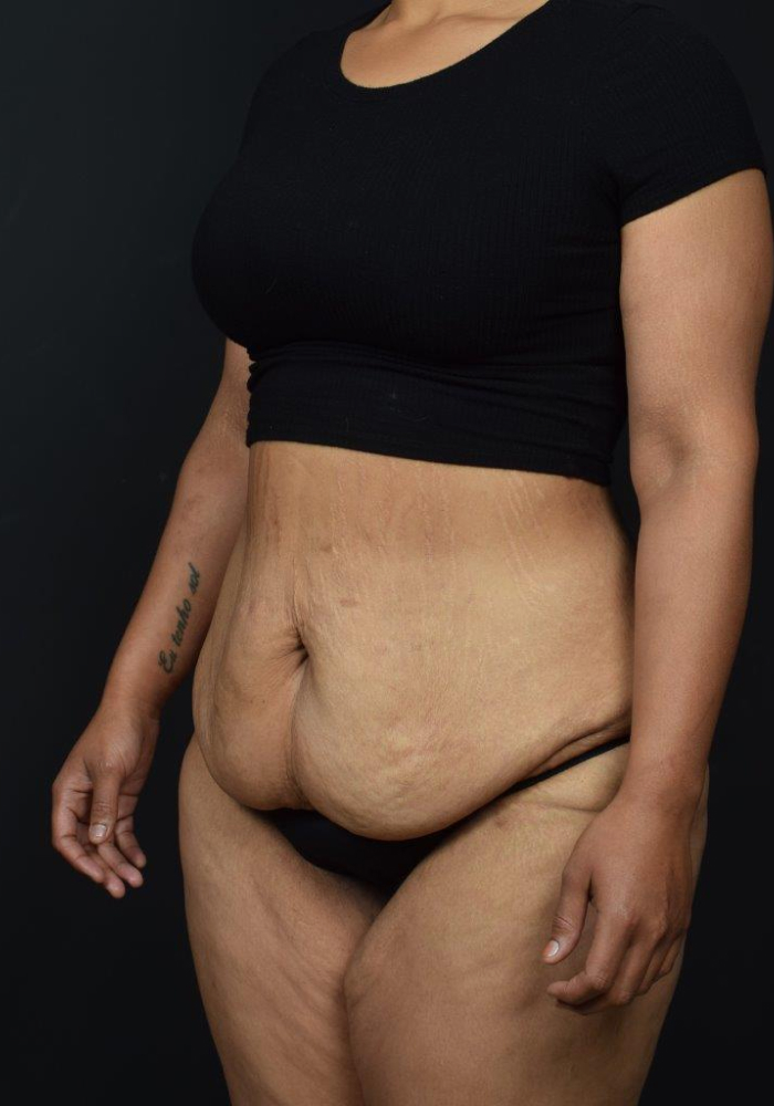 Tummy Tuck Before & After Image