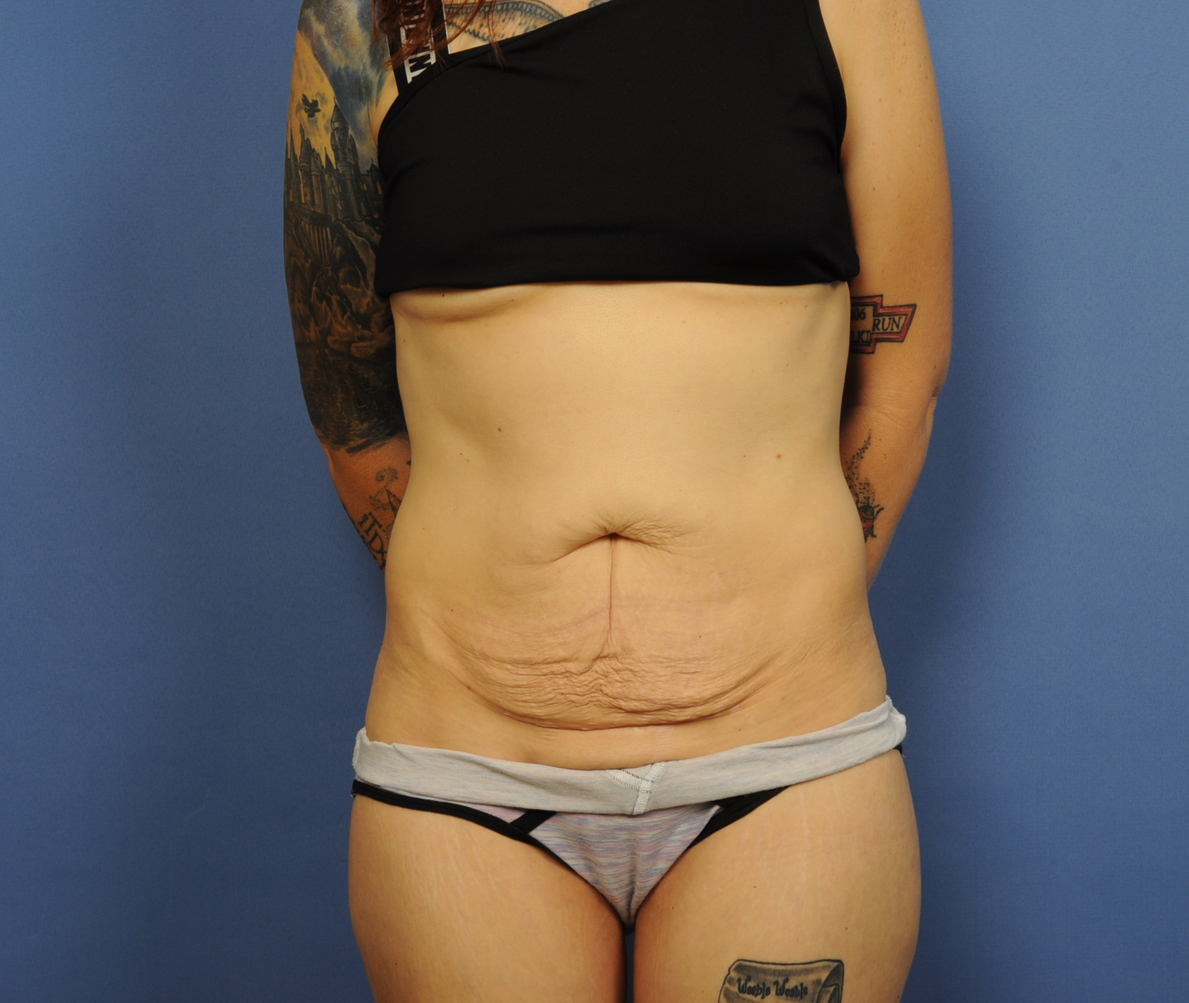 Tummy Tuck Before & After Image