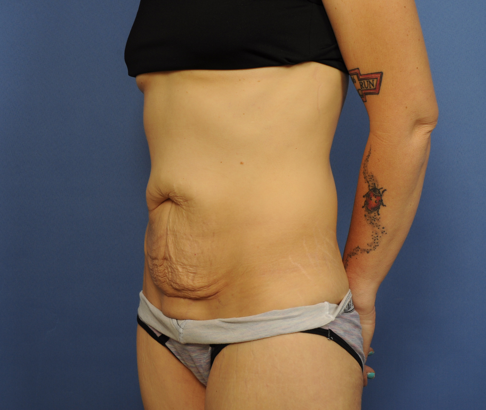 Tummy Tuck Before & After Image