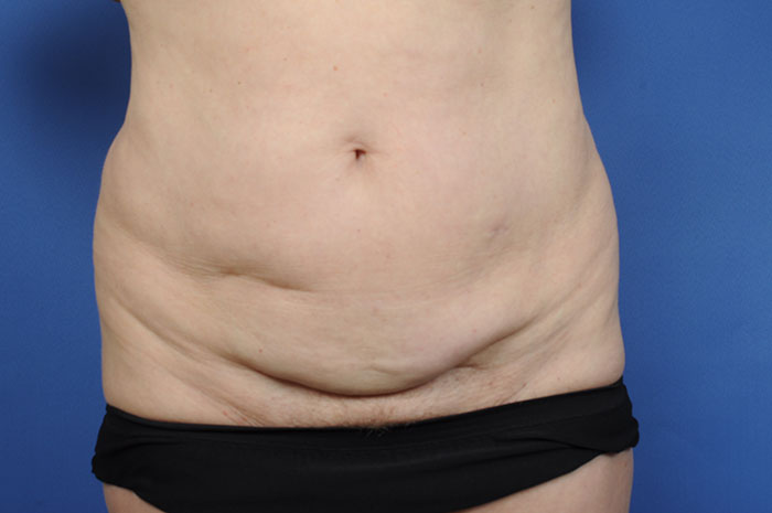 Tummy Tuck Before & After Image