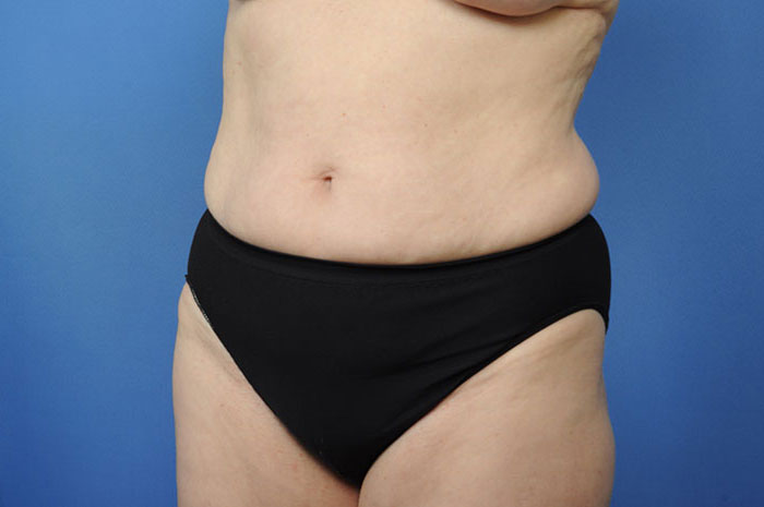 Tummy Tuck Before & After Image