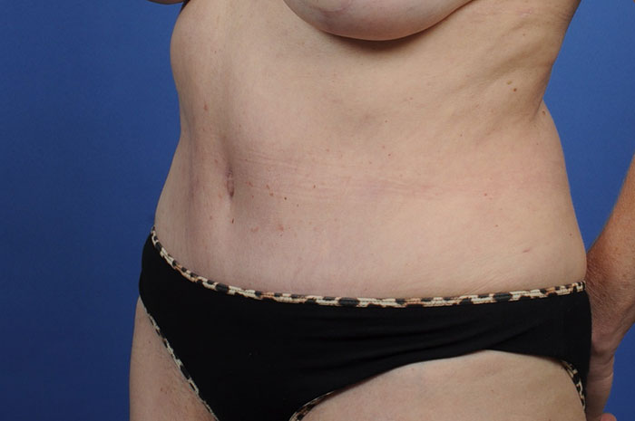 Tummy Tuck Before & After Image