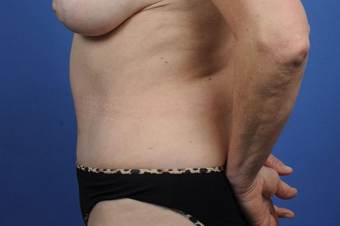 Tummy Tuck Before & After Image