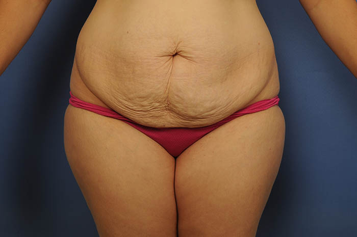 Tummy Tuck Before & After Image