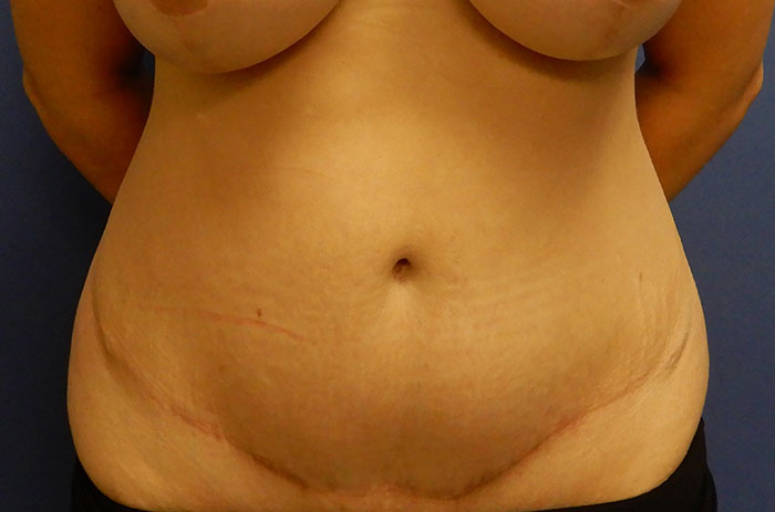 Tummy Tuck Before & After Image