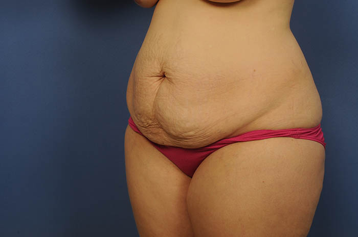 Tummy Tuck Before & After Image