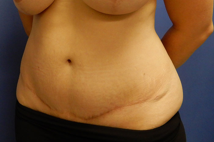 Tummy Tuck Before & After Image