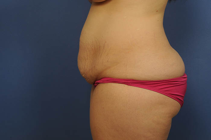 Tummy Tuck Before & After Image