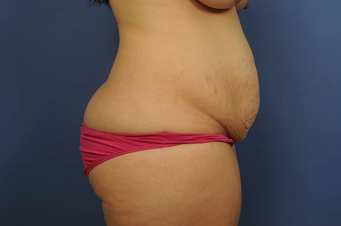 Tummy Tuck Before & After Image