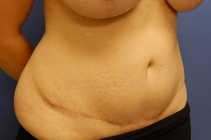 Tummy Tuck Before & After Image