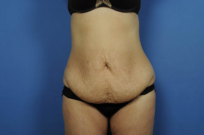 Tummy Tuck Before & After Image