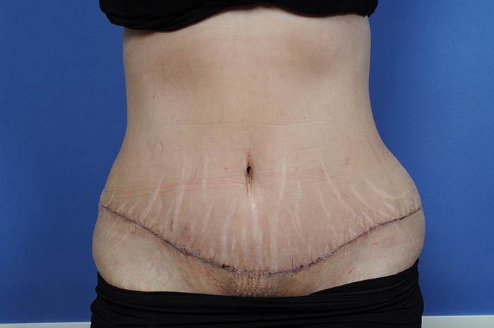 Tummy Tuck Before & After Image