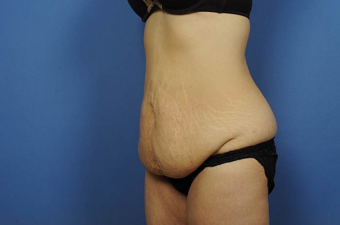 Tummy Tuck Before & After Image